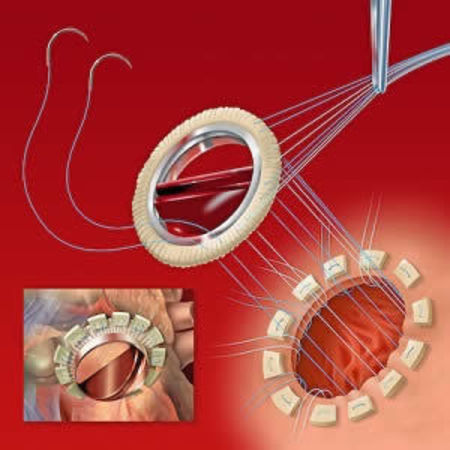 Imaging Assessment of Prosthetic Heart Valves