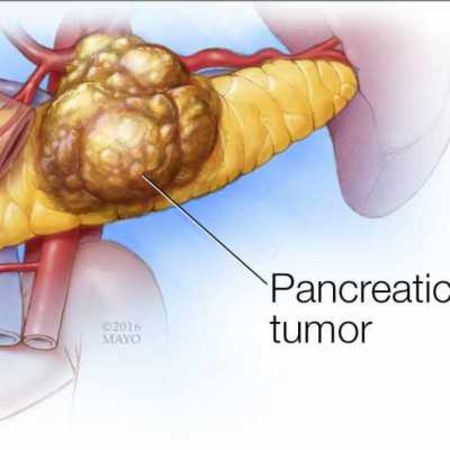 Chemo, Radiation, Surgery Combo Boosts Survival For Pancreatic Cancer