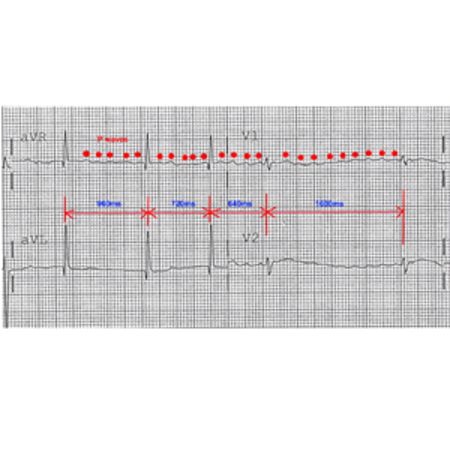 Social Inequality, Lifestyle and Heart Disease