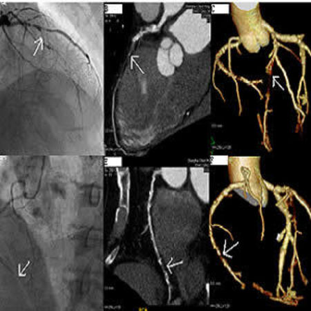 New Appropriate Use Criteria for Coronary Revascularisation