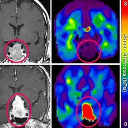 Magnetic Resonance Elastography as Tool for Surgical Planning
