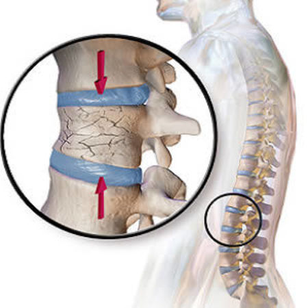 Radiology of Vertebral Fractures in Women and Men