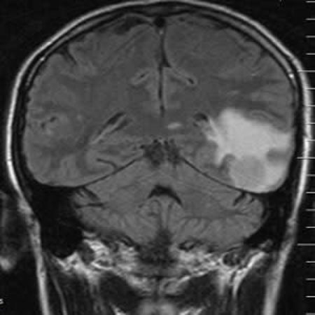 Quantitative FLAIR MRI in amyotrophic lateral sclerosis 