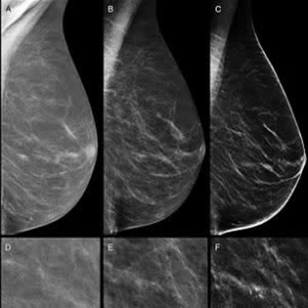 Combined digital screening detects more breast cancers