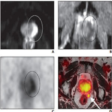 RSNA 2019: PSMA-based PET Radiotracers Transforming Care in Prostate Cancer