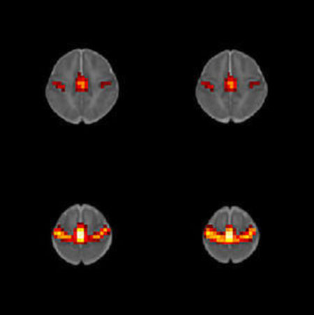 Prenatal Effect of Opioids