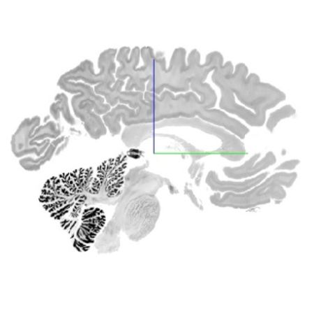 3D Brain Modelling by HIBALL