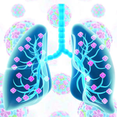 Selection Criteria for Lung Transplantation in COVID-19 Patients 