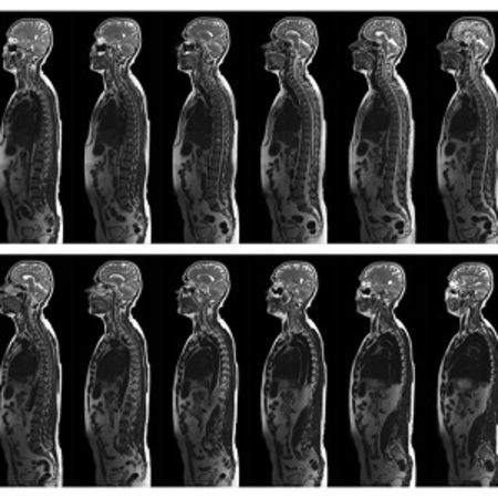 Deep Learning with Whole-body MRI Recognises Diabetes