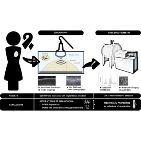 New Tool May Help Predict Breast Implant Rupture Risk