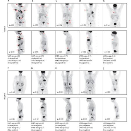 Deep Learning PET Imaging Model for Lymphoma Shows Clinical Potential