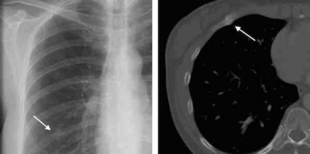 Radiologist Recommendations for Chest CT Clinically Relevant 