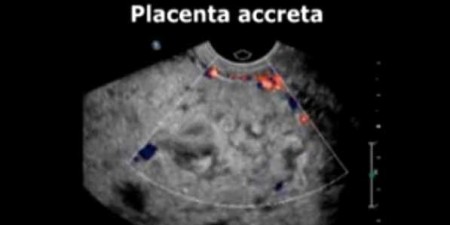 #RSNA14: Interventional Procedure Preserves Uterus in Patients with Placenta Accreta