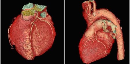 Routine CCTA Screening Not Necessary For Diabetics