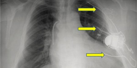 ICDs Improve Survival in Patients With Less Severe Heart Failure