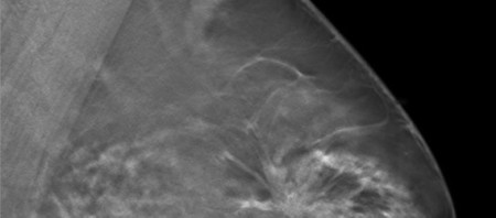 Photon-Counting Technique Increases Detection Rate in Screening Mammography  