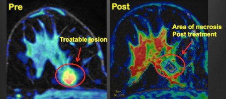 RSNA 2013: MR-guided Ultrasound Offers Noninvasive Treatment for Breast Cancer