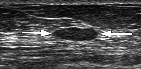 Ultrasound Lags MRI for Supplemental Breast Cancer Screening