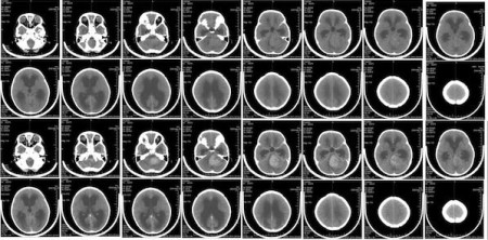 Radiation Risks in Paediatric CT: An Evaluation