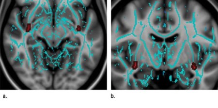 Concussions: Men Have Longer Recovery Time 