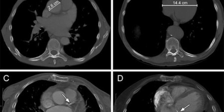 Chest CT Predicts Cardiovascular Risk