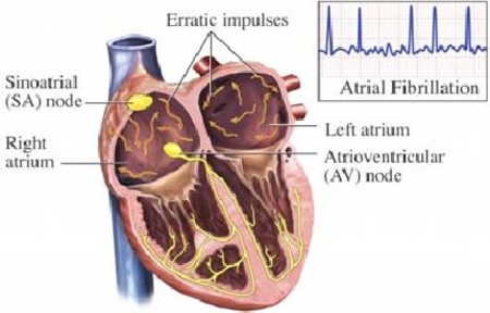 High Incidence of New-Onset AF in the ICU 