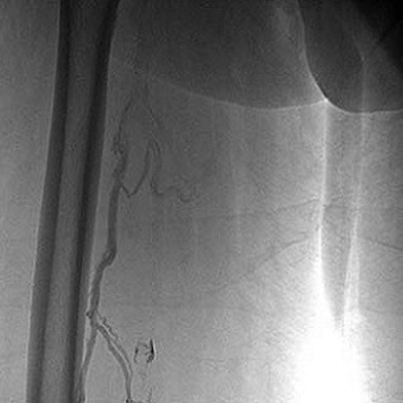 iliofemoral deep vein thrombosis