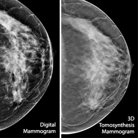 3D vs 2D mammography for detecting cancer in dense breasts