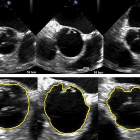 Selected frames of the original ultrasound images (left to right) and the region of interest (ROI) tracking results (top to bottom). Credit: Xiaoqun Zhang.