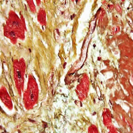 Myocardial Fibrosis Identified as New Therapeutic Target