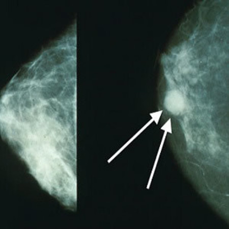 Radiologists Can Detect Breast Cancer in &#039;Blink of an Eye&#039;