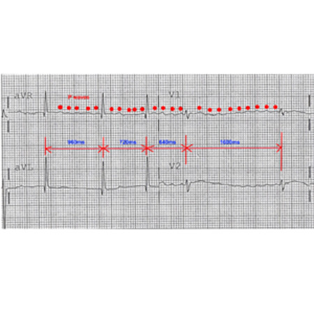 Social Inequality, Lifestyle and Heart Disease