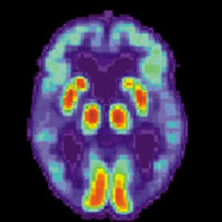 Amyloid PET improves evaluation of patients with cognitive impairment