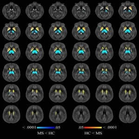 Image shows voxelwise analysis of quantitative susceptibility maps within thalamus, caudate, globus pallidus, and putamen comparing all participants with multiple sclerosis (MS) to healthy control (HC) participants. Areas of higher susceptibility in parti