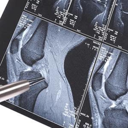 Muscle Injury  Radiology Key