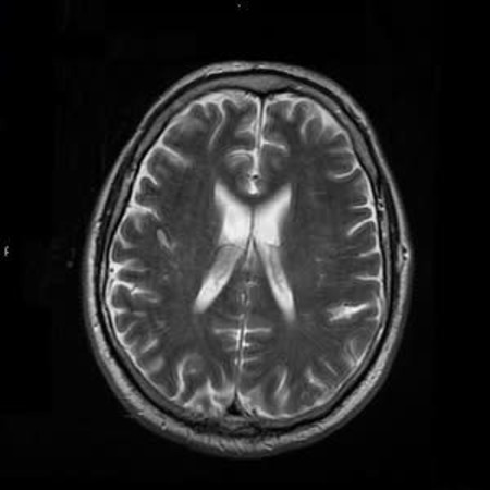 Stereotactic Radiotherapy for Small Cell Lung Cancer Brain Metastases 