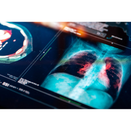 Clinical Decision Support Improve Pneumonia Outcomes