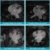 Performance of iNAV and dNAV Cardiac MRI Techniques for Atrial Fibrosis