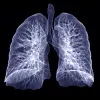 How to Better Manage Subsolid Lung Nodules?