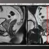 ESR Essentials: Prostate MRI Scoring System ESUR Recommendations