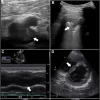 Multiorgan Ultrasound Reduces Diagnostic Imaging for Pulmonary Embolism