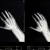 Exploring Radiopalmar Ganglion Cysts With Wrist MRI Studies