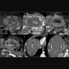 Understanding Peripheral Arterial Enhancement of Focal Liver Lesions