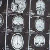 Unveiling Brain Flow: Advanced MRI for Neurological Diagnosis