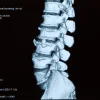 3D CT scan of the lumbar spine showing vertebrae and degenerative structural changes.&nbsp;