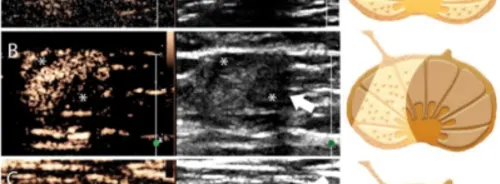 Nomogram Integrates CEUS &amp; Grayscale US to Predict Lymph Node Metastasis