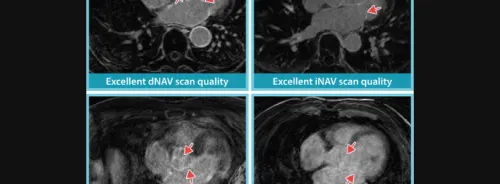 Performance of iNAV and dNAV Cardiac MRI Techniques for Atrial Fibrosis