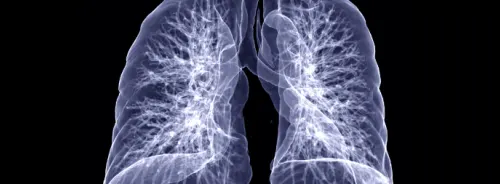 How to Better Manage Subsolid Lung Nodules?