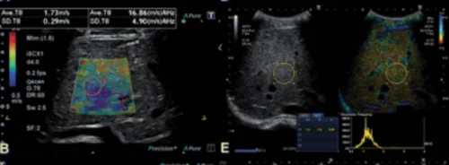 Assessing Liver Disease in Youth: A Comparative Study of Ultrasound and MRI Techniques