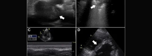 Multiorgan Ultrasound Reduces Diagnostic Imaging for Pulmonary Embolism